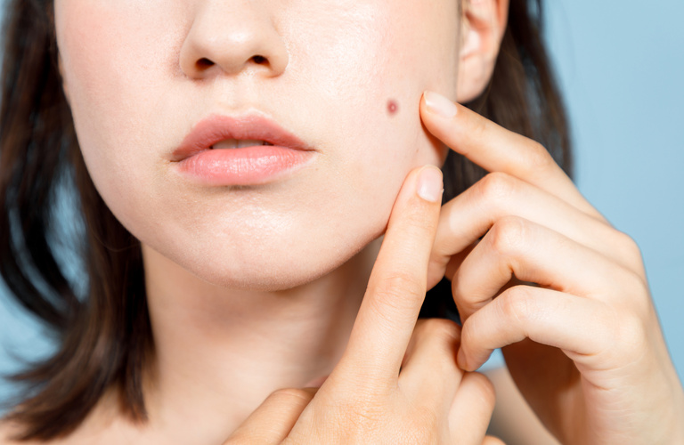 しつこいニキビの根本的な原因から追究 | 相模大野周辺のエステならアットホームなd'Arc facial treatment